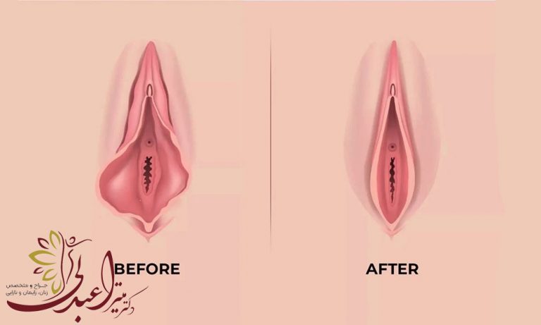 جراحی زیبایی زنان با لیزر