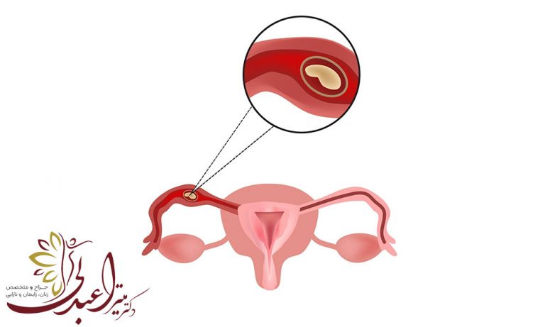 بارداری خارج از رحم چیست؟