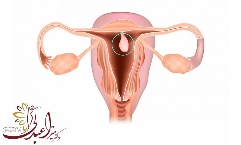 پولیپ رحم چیست؟