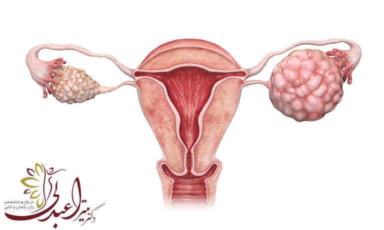 سرطان تخمدان چیست و درمان آن