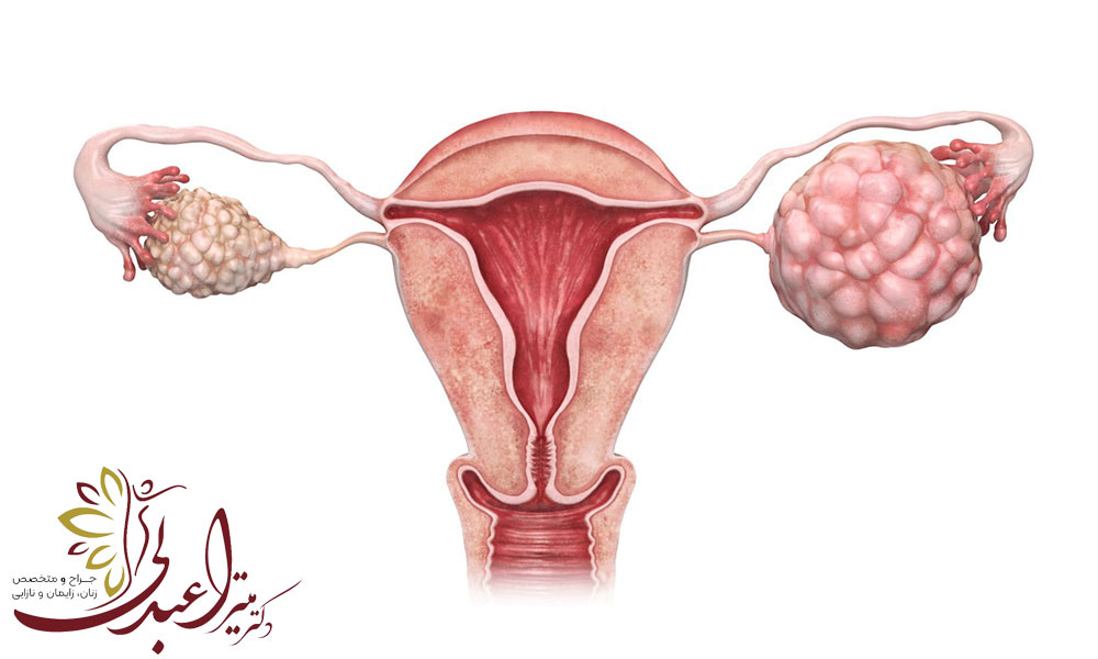 سرطان تخمدان چیست و درمان آن