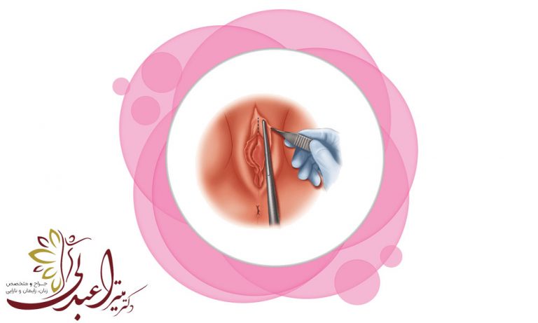 لابیاپلاستی و رضایت جنسی