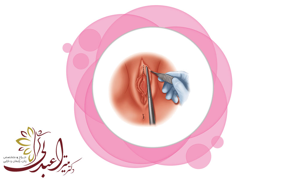 لابیاپلاستی و رضایت جنسی