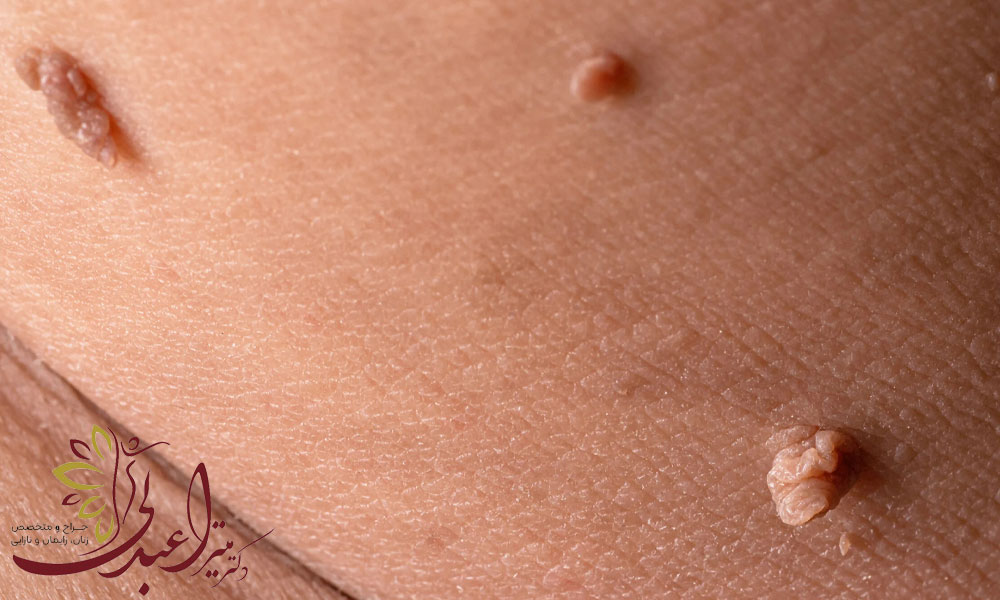 راه های انتقال زگیل تناسلی