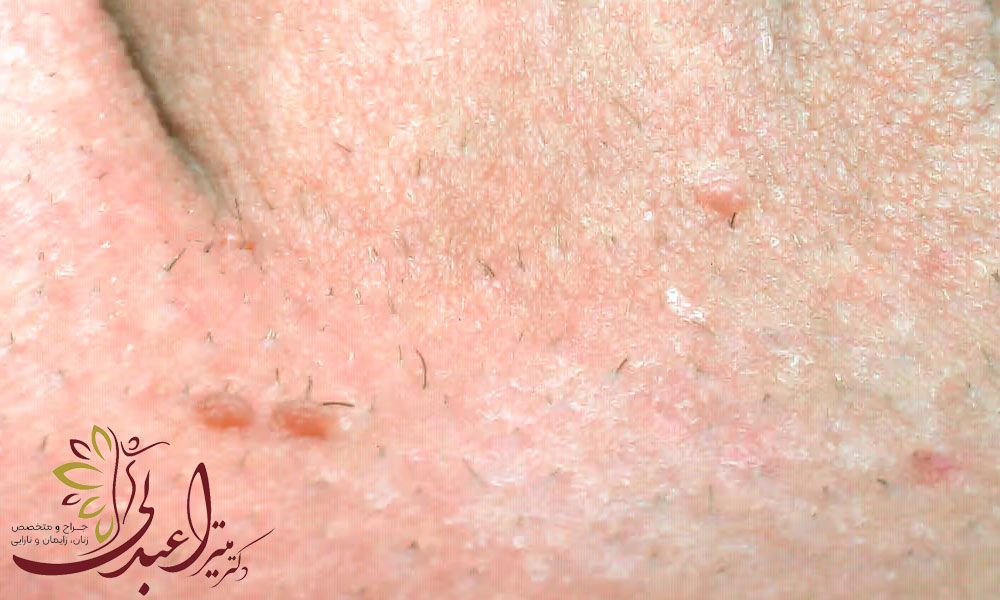 راه های انتقال زگیل تناسلی