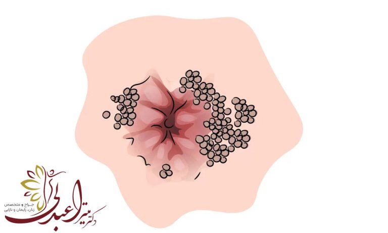 بهترین دکتر زگیل تناسلی زنان در تهران