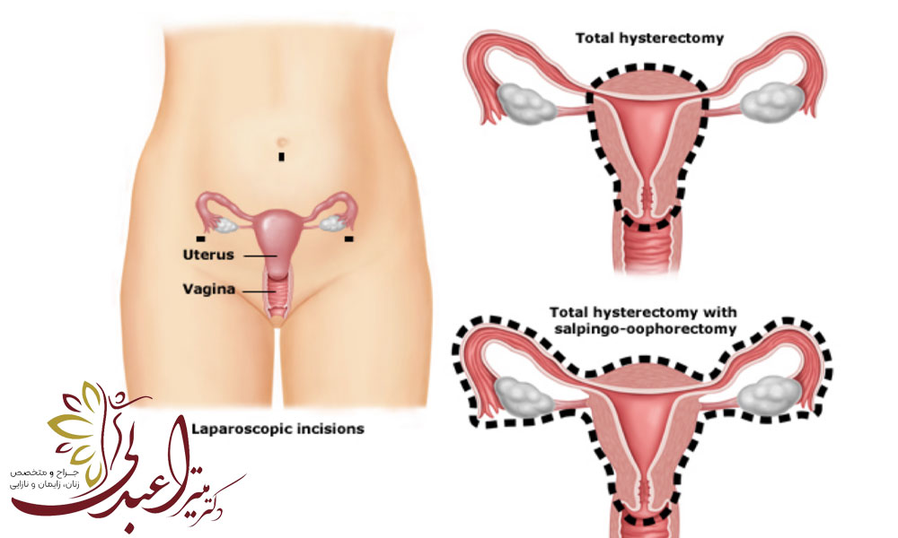 عمل هیسترکتومی