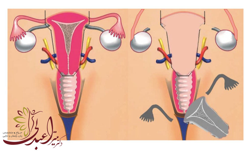 عمل هیسترکتومی